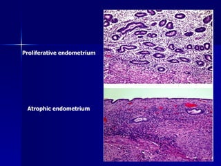 Proliferative endometrium
Atrophic endometrium
 