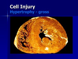 Cell Injury
Cell Injury
Hypertrophy - gross
Hypertrophy - gross
 