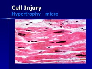 Cell Injury
Cell Injury
Hypertrophy - micro
Hypertrophy - micro
 