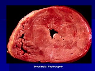 Myocardial hypertrophy
 