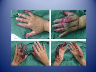  Desequilibrio Nutricional: Deficiencia de proteínas y calorías o vitaminas