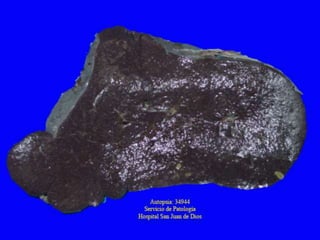 La Hinchazón celular es reversible Lesión CelularCambio Graso:Es producto de una lesión Hipóxica, toxicas, etc.