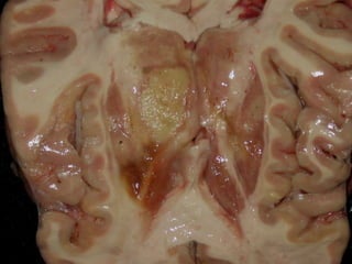  Es reversibleLesión CelularNecrosis:Es una serie de cambios que acompañan a la muerte celular