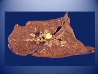 Lesión CelularNecrosis:Es una serie de cambios que acompañan a la muerte celular