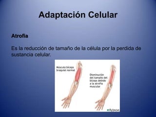 MetaplasiaAdaptación CelularHipertrofiaEs el aumento del tamaño de las células, lo que da lugar a un crecimiento de tamaño del órgano.