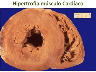 Hipertrofia músculo Cardíaco
 