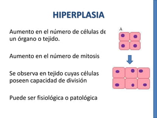 HIPERPLASIA
Aumento en el número de células de
un órgano o tejido.
Aumento en el número de mitosis
Se observa en tejido cuyas células
poseen capacidad de división
Puede ser fisiológica o patológica
 