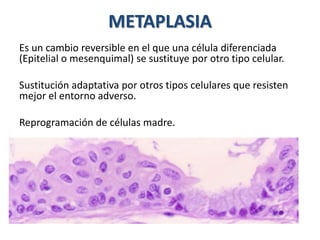 METAPLASIA
Es un cambio reversible en el que una célula diferenciada
(Epitelial o mesenquimal) se sustituye por otro tipo celular.
Sustitución adaptativa por otros tipos celulares que resisten
mejor el entorno adverso.
Reprogramación de células madre.
 