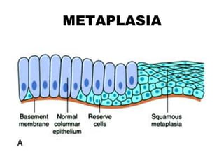 METAPLASIA
 