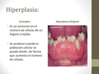 Hiperplasia:
        Concepto:           Hiperplasia Gingival:
• Es un aumento en el
  numero de células de un
  órgano o tejido.

• Se produce cuando la
  población celular se
  puede dividir, de forma
  que aumenta el número
  de células.
 