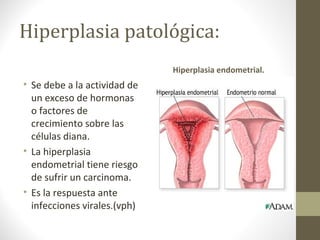 Hiperplasia patológica:
• Se debe a la actividad de
un exceso de hormonas
o factores de
crecimiento sobre las
células diana.
• La hiperplasia
endometrial tiene riesgo
de sufrir un carcinoma.
• Es la respuesta ante
infecciones virales.(vph)
Hiperplasia endometrial.
 