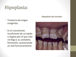 Hipoplasia:
• Trastorno de origen
congénito.
• Es el crecimiento
insuficiente de un tejido
u órgano por el que este
no llega a su completa
formación, ocasionando
un mal funcionamiento.
Hipoplasia del esmalte:
 