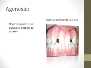 Agenesia:
• Ocurre cuando ni si
quiera se detecta tal
esbozo.
Agenesia en incisivos laterales.
 