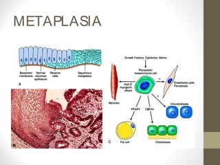 METAPLASIA
 