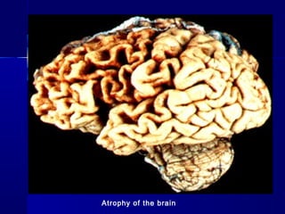 Atrophy of the brain
 