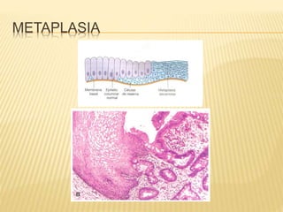 METAPLASIA
 