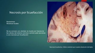 Necrosis por licuefacción
Bacterianas
Micóticas focales
No se conocen con claridad, la muerte por hipoxia de
las células del sistema nervioso central suele asociarse
a una necrosis por licuefacción
Necrosis licuefactiva. Infarto cerebral que muestra disolución del tejido
 