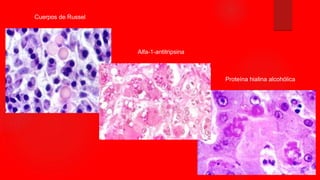 Cuerpos de Russel
Alfa-1-antitripsina
Proteína hialina alcohólica
 
