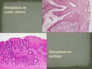 Metaplasia de
cuello uterino
Metaplasia en
esófago
 
