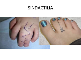 SINDACTILIA
 