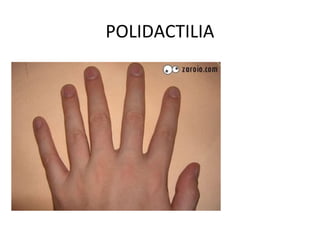 POLIDACTILIA
 