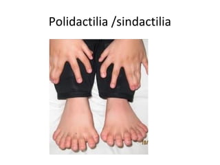 Polidactilia /sindactilia
 