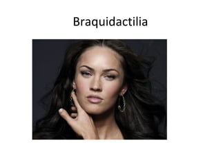 Braquidactilia
 