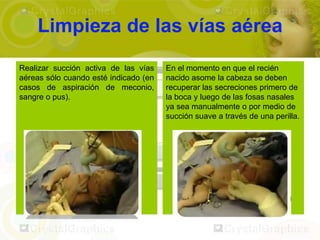 Limpieza de las vías aérea
Realizar succión activa de las vías    En el momento en que el recién
aéreas sólo cuando esté indicado (en   nacido asome la cabeza se deben
casos de aspiración de meconio,        recuperar las secreciones primero de
sangre o pus).                         la boca y luego de las fosas nasales
                                       ya sea manualmente o por medio de
                                       succión suave a través de una perilla.
 