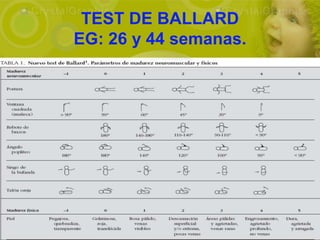 TEST DE BALLARD
EG: 26 y 44 semanas.
 