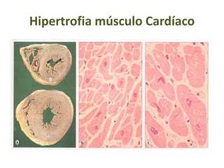 Hipertrofia músculo Cardíaco
 