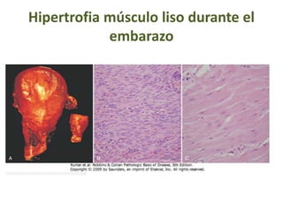 Hipertrofia músculo liso durante el
embarazo
 