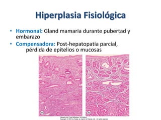 Hiperplasia Fisiológica
• Hormonal: Gland mamaria durante pubertad y
embarazo
• Compensadora: Post-hepatopatia parcial,
pérdida de epitelios o mucosas
 