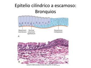 Epitelio cilíndrico a escamoso:
Bronquios
 