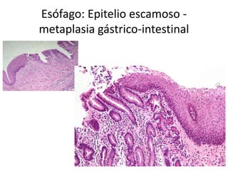 Esófago: Epitelio escamoso -
metaplasia gástrico-intestinal
 