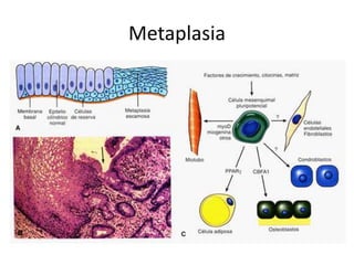 Metaplasia
 