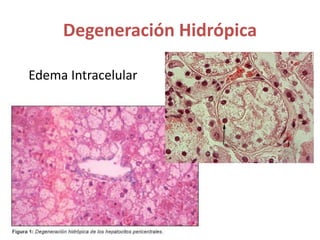 Degeneración Hidrópica
Edema Intracelular
 