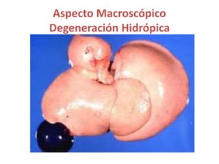 Aspecto Macroscópico
Degeneración Hidrópica
 