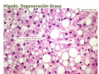 Hígado. Degeneración Grasa
 