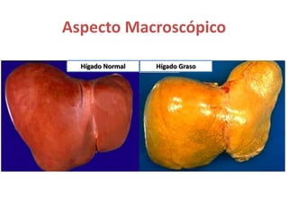 Aspecto Macroscópico
Hígado Normal Hígado Graso
 
