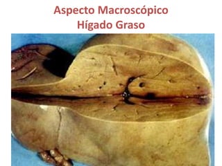 Aspecto Macroscópico
Hígado Graso
 