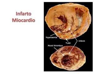 Infarto
Miocardio
 