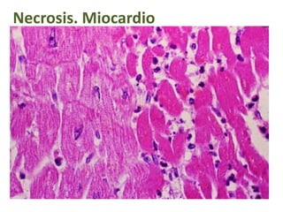 Necrosis. Miocardio
 