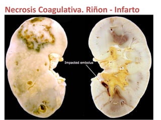 Necrosis Coagulativa. Riñon - Infarto
 