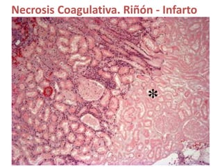 Necrosis Coagulativa. Riñón - Infarto
 