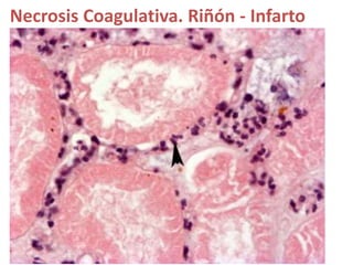 Necrosis Coagulativa. Riñón - Infarto
 