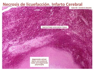 Necrosis de licuefacción. Infarto Cerebral
 