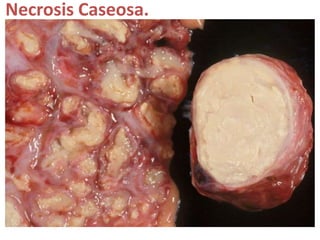 Necrosis Caseosa.
 