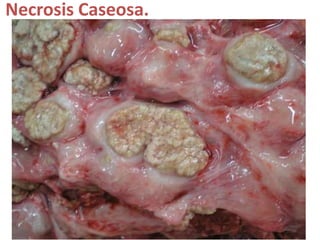 Necrosis Caseosa.
 