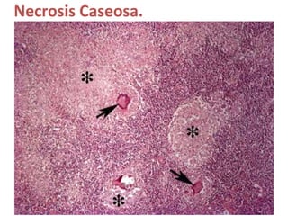 Necrosis Caseosa.
 