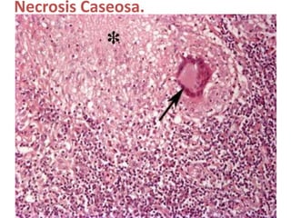 Necrosis Caseosa.
 